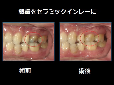銀歯をセラミックインレーに‼その２ スタッフブログ 熊本でインプラント、ホワイトニングならサンフラワーデンタルクリニック！熊本市上通の審美歯科。