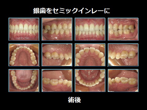 銀歯をセラミックインレーに‼その２ スタッフブログ 熊本でインプラント、ホワイトニングならサンフラワーデンタルクリニック！熊本市上通の審美歯科。